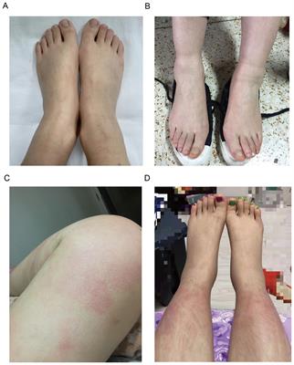 Expanding clinical characteristics and genotypic profiling of Yao syndrome in Chinese patients